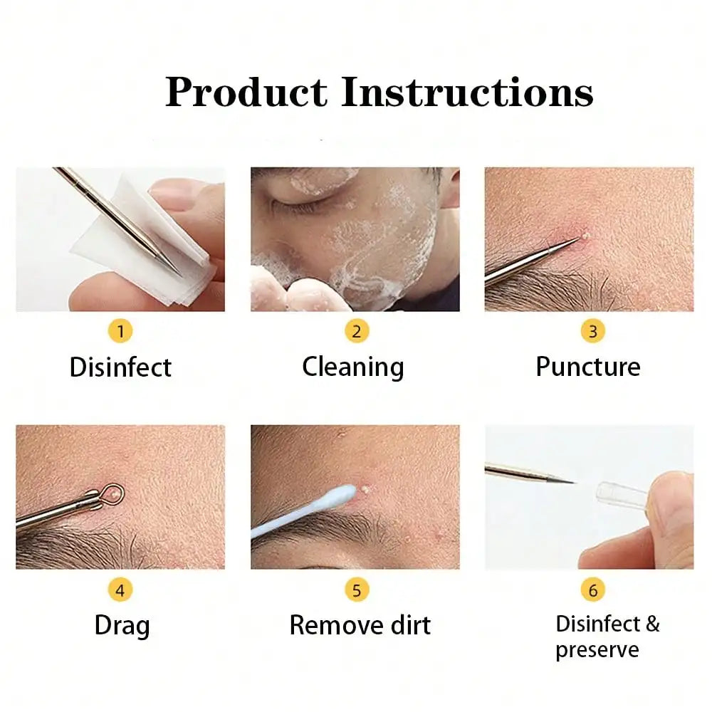 Professional Blackhead Extractor Set – 4 Piece